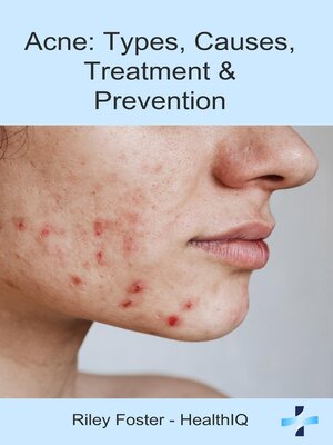cover image of Acne